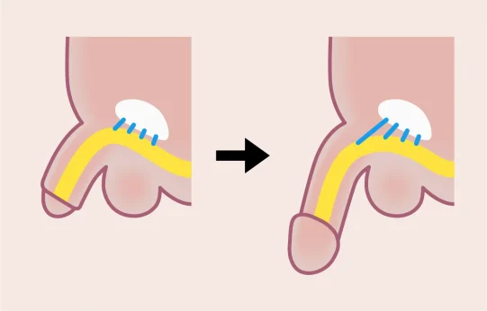 アトムクリニック切らない長茎手術参考画像