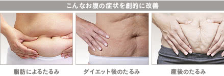 ザ・クリニック切らないタミータックの画像