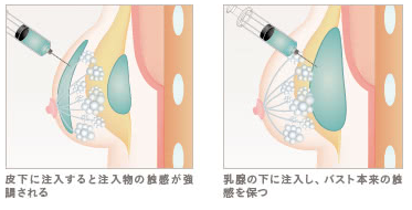 ザ・クリニックヒアルロン酸注入方法