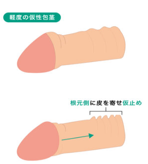 東京ノーストクリニックの切らない包茎手術(接着剤固定)