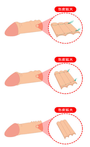 東京ノーストクリニックの切らない包茎手術(縫合糸固定)