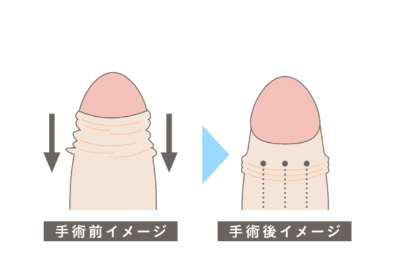 FINクリニック切らない包茎手術画像