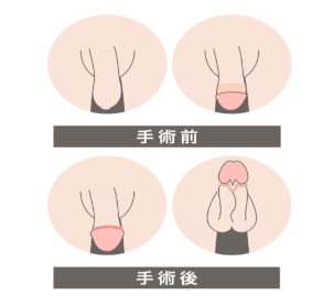 FINクリニック環状切開法