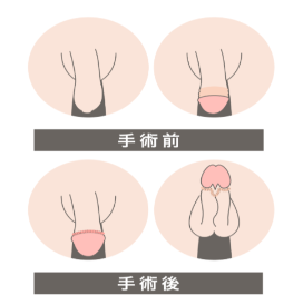 FINクリニック亀頭直下法