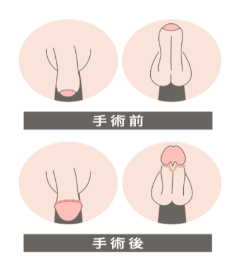 FINクリニック小帯形成・陰茎縫線手術