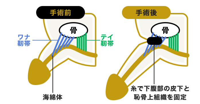 アトムクリニックの切らない長茎術